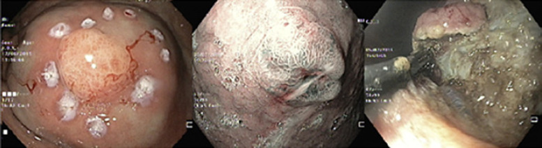 Endoscopic Resection of Gastrointestinal Neuroendocrine Tumors: Long-Term Outcomes and Comparison of Endoscopic Techniques.