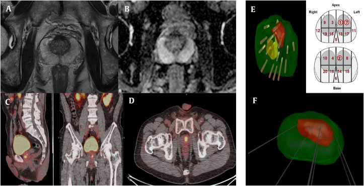 Irreversible electroporation for prostate cancer using PSMA PET-CT