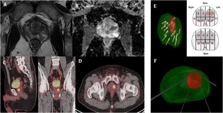 Irreversible electroporation for prostate cancer using PSMA PET-CT