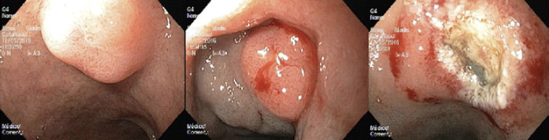 Endoscopic Resection of Gastrointestinal Neuroendocrine Tumors: Long-Term Outcomes and Comparison of Endoscopic Techniques.