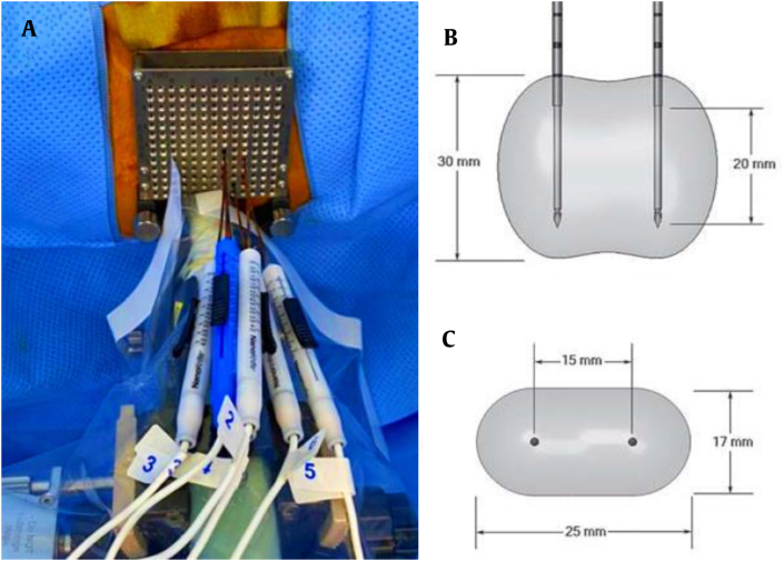 Irreversible electroporation for prostate cancer using PSMA PET-CT