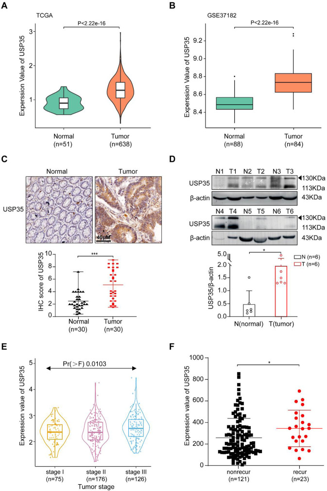 USP35 promotes cell proliferation and chemotherapeutic resistance through stabilizing FUCA1 in colorectal cancer.