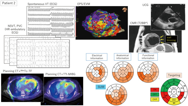 Interim Report of a Japanese Phase II Trial for Cardiac Stereotactic Body Radiotherapy in Refractory Ventricular Tachycardia　- Focus on Target Determination.