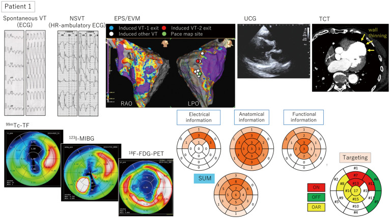 Interim Report of a Japanese Phase II Trial for Cardiac Stereotactic Body Radiotherapy in Refractory Ventricular Tachycardia　- Focus on Target Determination.