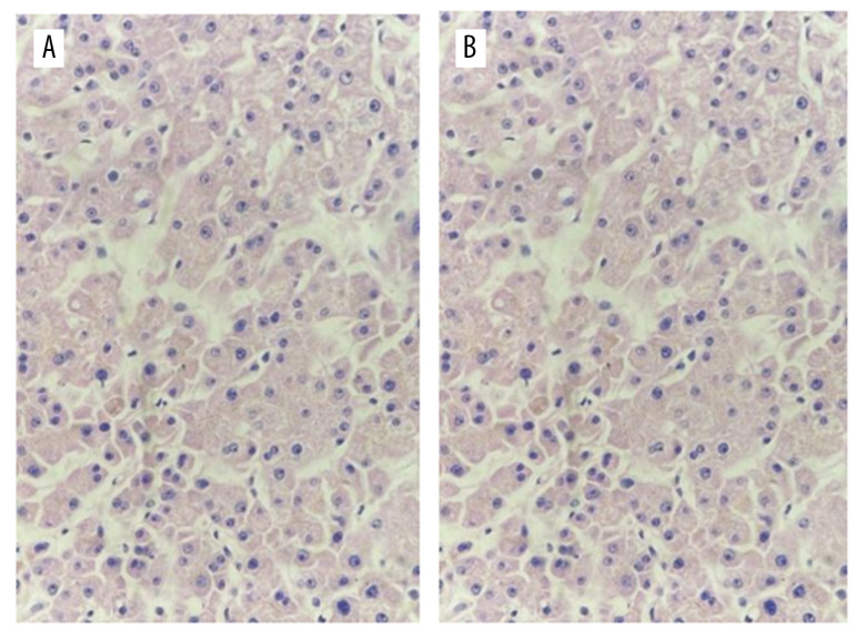 Evaluation and Use of Organs from Donors Poisoned by Organophosphorus Pesticide.