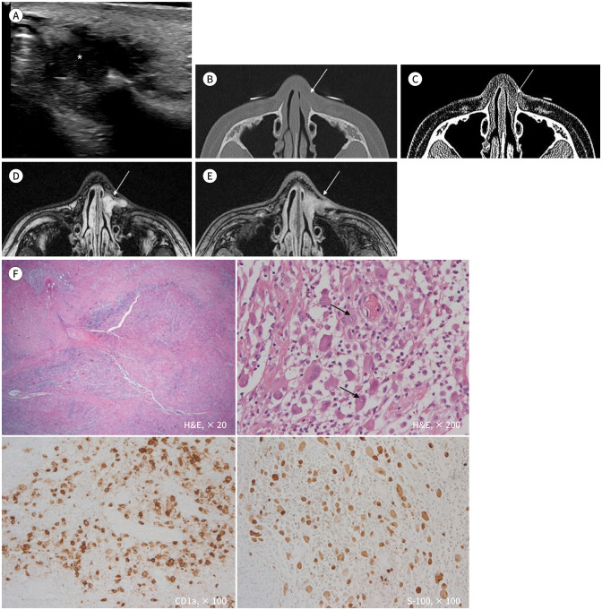 Langerhans Cell Histiocytosis in the Nasal Bone: A Rare Case.