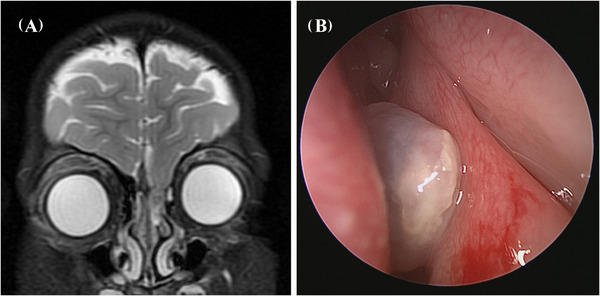 Bath-plug technique for the endoscopic management of cerebrospinal fluid leaks in children.