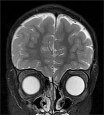 Bath-plug technique for the endoscopic management of cerebrospinal fluid leaks in children.