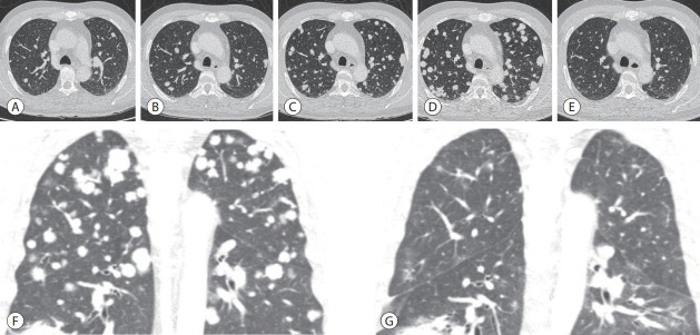 A case of nearly complete response in hepatocellular carcinoma with disseminated lung metastasis by combination therapy of nivolumab and ipilimumab after treatment failure of atezolizumab plus bevacizumab.