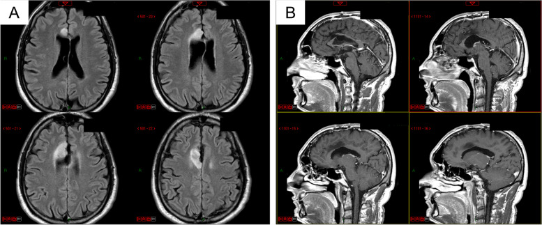 Right gyrus cinguli low-grade astrocytoma recurrence removed through a contralateral transfalcine approach with a 4K-3D exoscope.