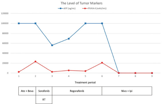 A case of nearly complete response in hepatocellular carcinoma with disseminated lung metastasis by combination therapy of nivolumab and ipilimumab after treatment failure of atezolizumab plus bevacizumab.