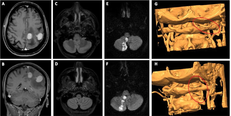 Cerebellar Ischemic Stroke Secondary to Rotational Non-Dominant Vertebral Artery Occlusion (RVAO): A Rare Complication Following Supratentorial Surgery.