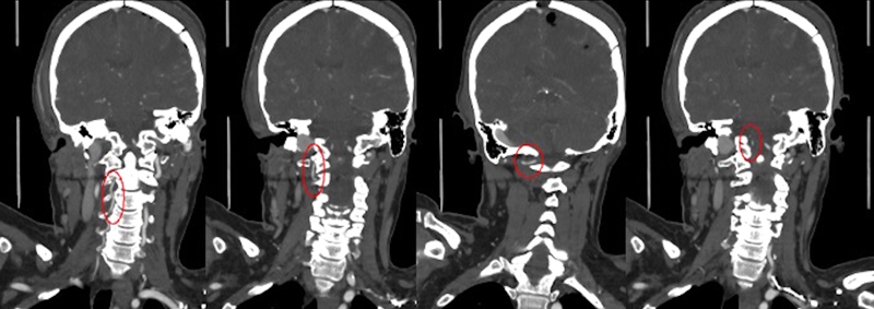 Cerebellar Ischemic Stroke Secondary to Rotational Non-Dominant Vertebral Artery Occlusion (RVAO): A Rare Complication Following Supratentorial Surgery.