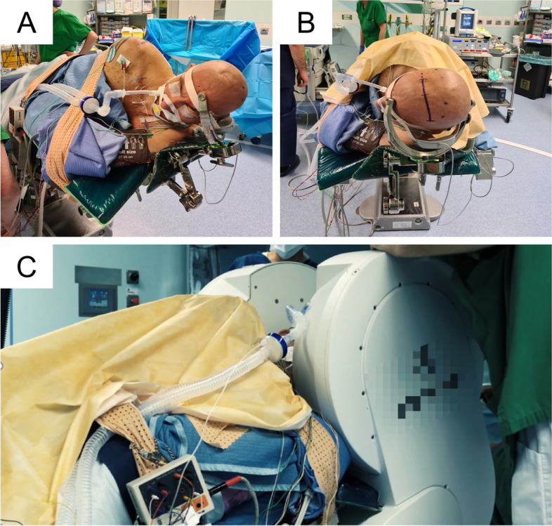 Right gyrus cinguli low-grade astrocytoma recurrence removed through a contralateral transfalcine approach with a 4K-3D exoscope.