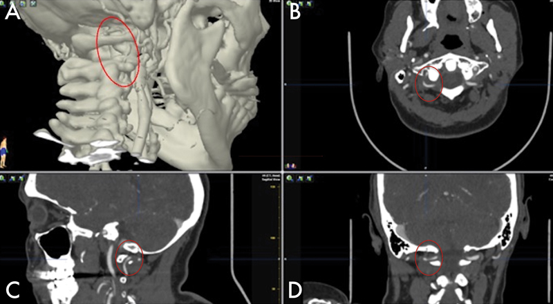 Cerebellar Ischemic Stroke Secondary to Rotational Non-Dominant Vertebral Artery Occlusion (RVAO): A Rare Complication Following Supratentorial Surgery.