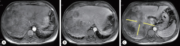 A case of nearly complete response in hepatocellular carcinoma with disseminated lung metastasis by combination therapy of nivolumab and ipilimumab after treatment failure of atezolizumab plus bevacizumab.