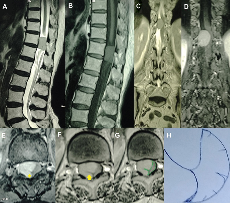 Gingko Leaf Sign: A Classical Imaging Finding in Spinal Meningiomas.