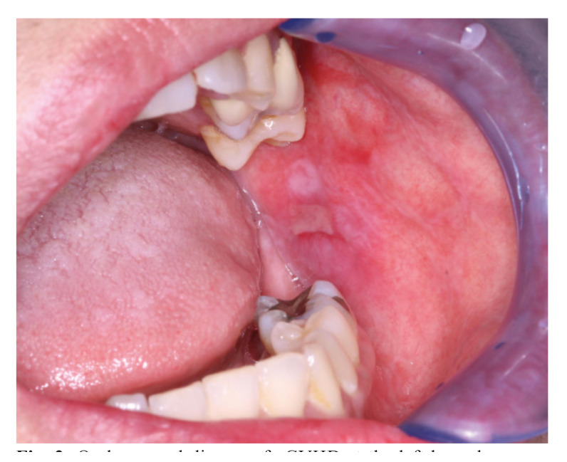 Clinical characteristics of oral chronic graft-versus-host disease according to the 2014 National Institutes of Health (USA) consensus criteria.