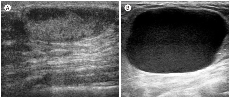 [Ultrasound-Guided Intervention for Breast Lesions].