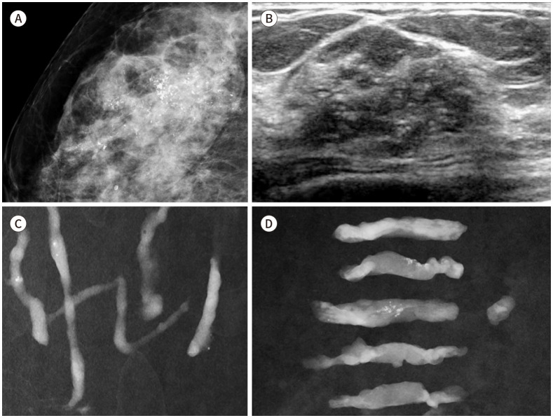 [Ultrasound-Guided Intervention for Breast Lesions].