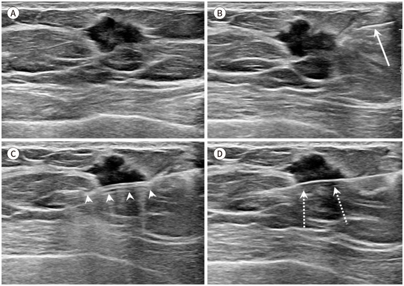 [Ultrasound-Guided Intervention for Breast Lesions].