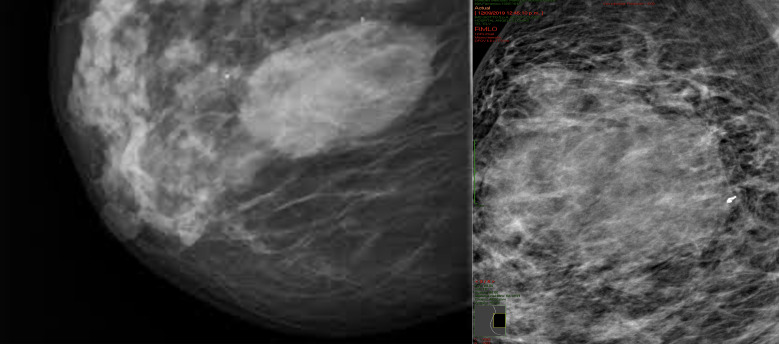 Primary breast B-cell non-Hodgkin’s lymphoma of the breast. Case Report and review of the literature