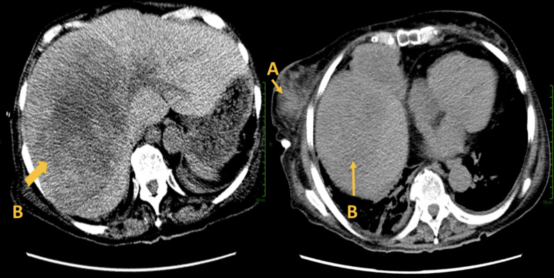 Primary breast B-cell non-Hodgkin’s lymphoma of the breast. Case Report and review of the literature