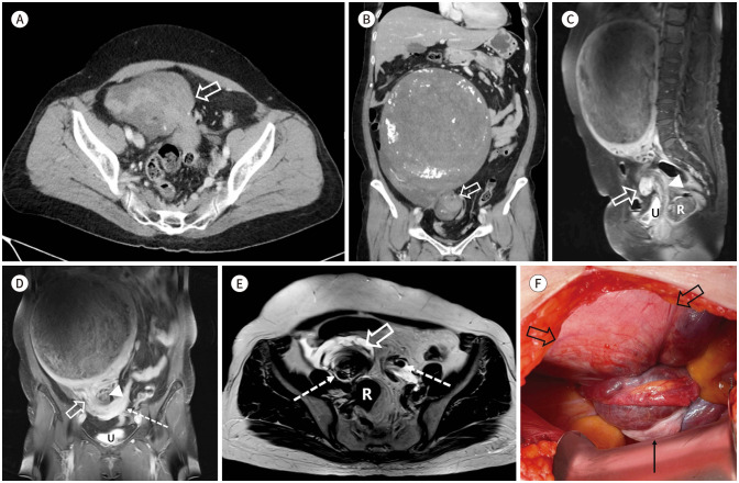 [Torsion of a Myomatous Uterus in a Non-Gravid Female: A Case Report].