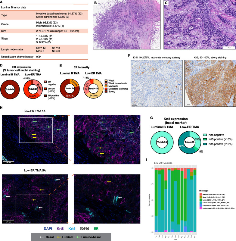 Lineage plasticity enables low-ER luminal tumors to evolve and gain basal-like traits.