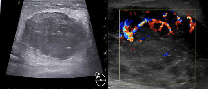 Primary breast B-cell non-Hodgkin’s lymphoma of the breast. Case Report and review of the literature