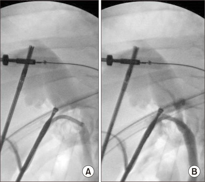 Mirizzi syndrome complicated by type IV cholecystobiliary fistula to the right hepatic duct.