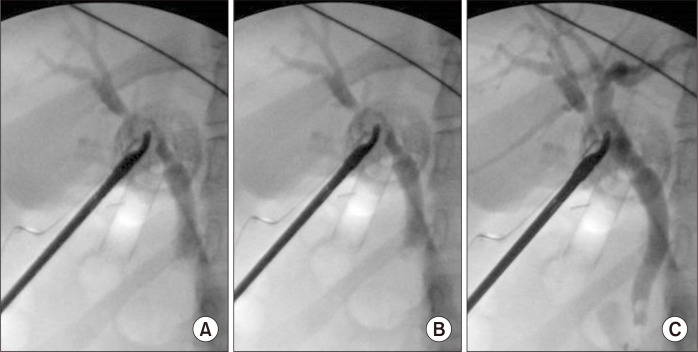 Mirizzi syndrome complicated by type IV cholecystobiliary fistula to the right hepatic duct.