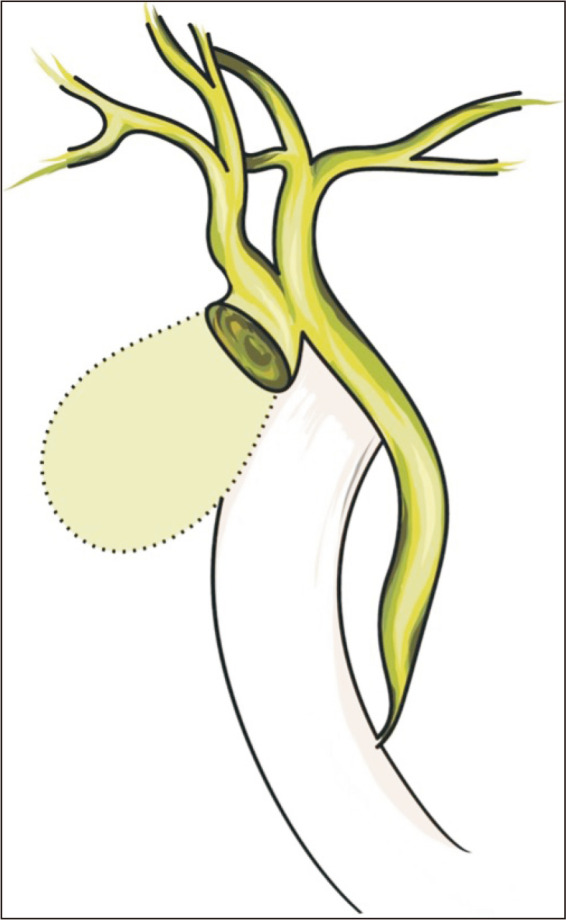 Mirizzi syndrome complicated by type IV cholecystobiliary fistula to the right hepatic duct.