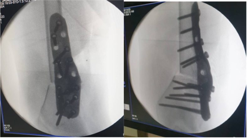 Local design and manufacturing of patient-specific implant using Anatomage Medical Design Studio software: proof of concept - Botswana's 1st case report.