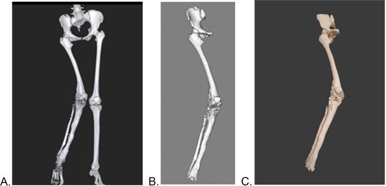 Local design and manufacturing of patient-specific implant using Anatomage Medical Design Studio software: proof of concept - Botswana's 1st case report.