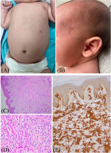 Congenital cutaneous mastocytosis mistaken for non-accidental injury.