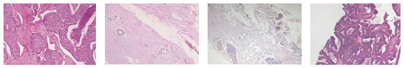 A Survey of Convolutional Neural Network in Breast Cancer.