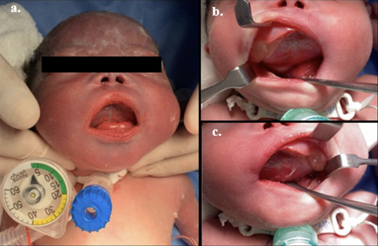 Immature nasopharyngeal teratoma with prenatal diagnosis: Case report and review of the literature