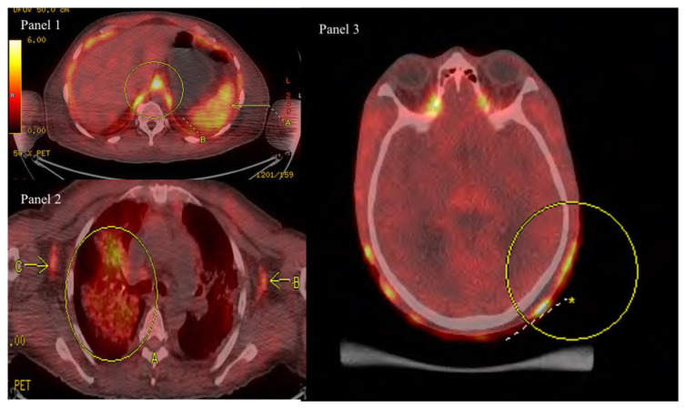 Pyoderma Gangrenosum as a Harbinger of Adult T-Cell Leukemia-Lymphoma.