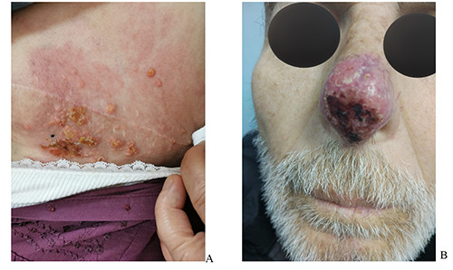 Cutaneous metastases different clinical presentations: case series and review of the literature.