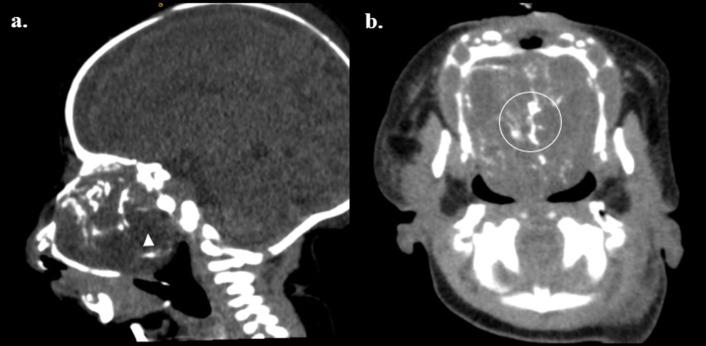 Immature nasopharyngeal teratoma with prenatal diagnosis: Case report and review of the literature