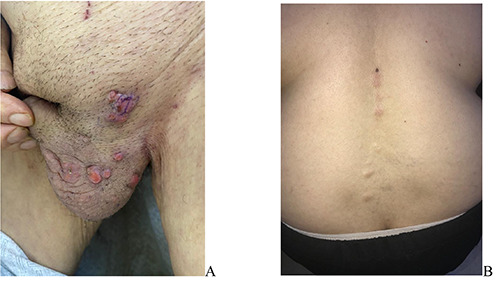 Cutaneous metastases different clinical presentations: case series and review of the literature.