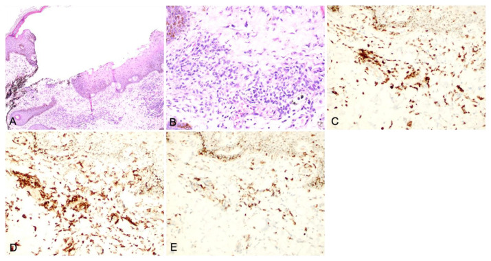 Pyoderma Gangrenosum as a Harbinger of Adult T-Cell Leukemia-Lymphoma.