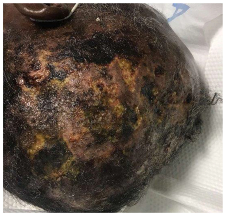 Pyoderma Gangrenosum as a Harbinger of Adult T-Cell Leukemia-Lymphoma.