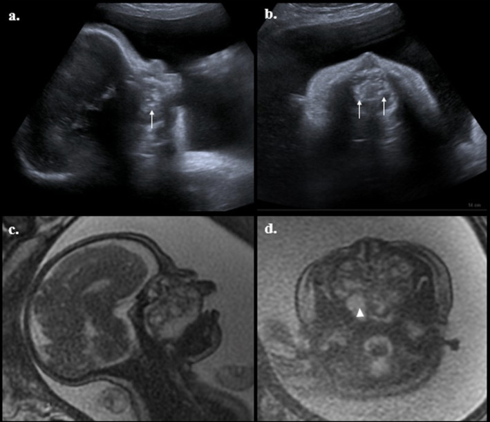 Immature nasopharyngeal teratoma with prenatal diagnosis: Case report and review of the literature