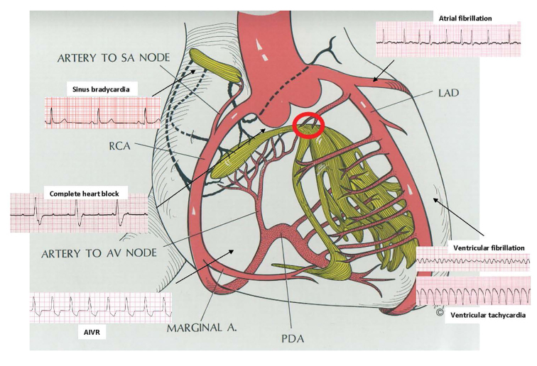 Arrhythmias After Acute Myocardial Infarction.