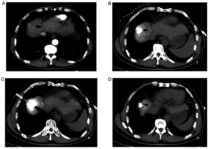 Percutaneous microwave ablation‑induced hepatic artery‑pulmonary artery fistula: A rare case report.