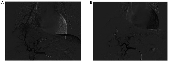 Percutaneous microwave ablation‑induced hepatic artery‑pulmonary artery fistula: A rare case report.