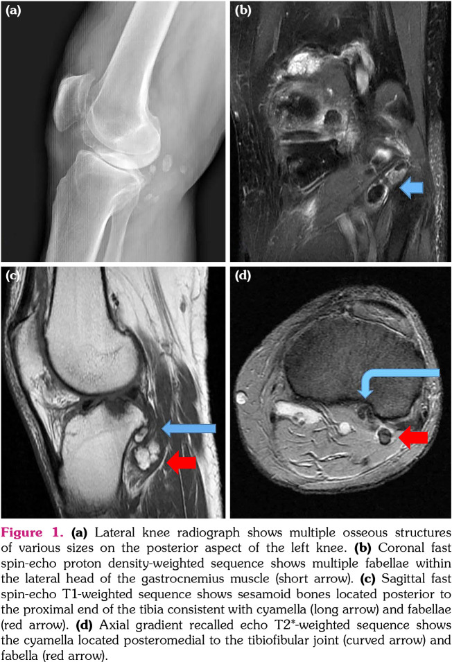 Coexistence of symptomatic cyamella and multiple fabellae: A case report.