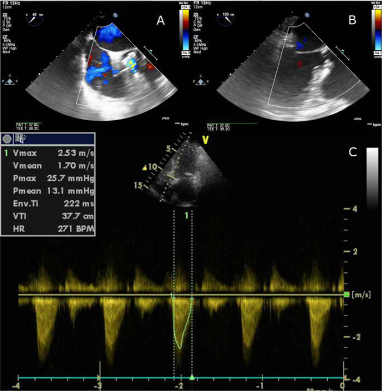 Use of Boston Accurate Neo transcatheter aortic valve for valve-in-valve procedure in 82-year-old patient with Medtronic Mosaic bioprosthesis.